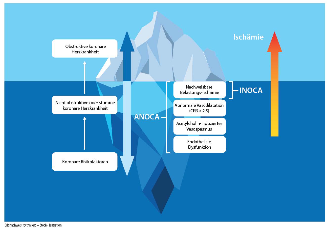 ANOCA und INOCA – der unsichtbare Koloss unter der Wasseroberfläche der obstruktiven KHK